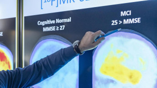 Servono 3,5-4,1 anni per diagnosi Alzheimer da comparsa sintomi