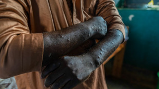 Epid&eacute;mie de mpox: l'OMS maintient son plus haut niveau d'alerte 