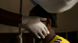 Raros brotes de viruela del mono detectados en Norteam&eacute;rica y Europa