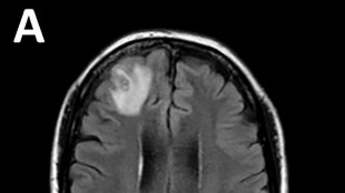 Un ver qui parasite les serpents d&eacute;couvert dans le cerveau d'une Australienne  