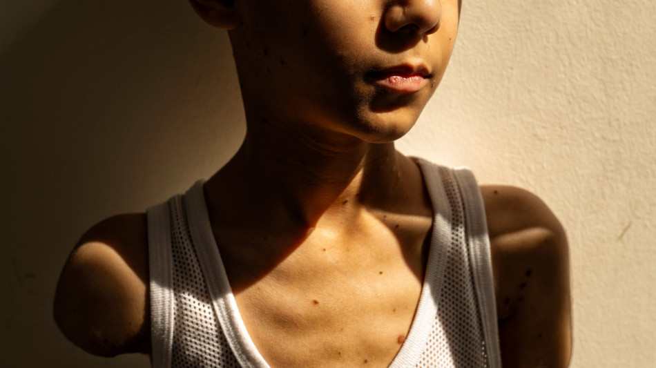 World Press Photo, il bambino amputato a Gaza &egrave; foto dell'anno